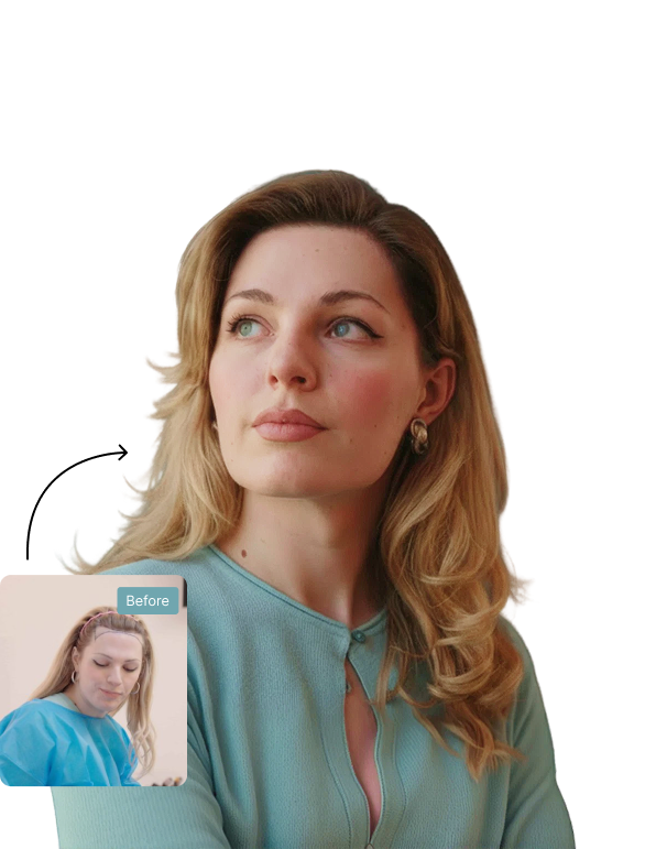 Nadia before and after eyebrow transplant